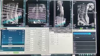 MRI LS SPINE FULL PLANNING WITH FILMING UNITED IMAGING MRI MACHINE