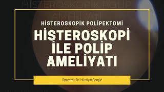 HİSTEROSKOPİ İLE RAHİM İÇİ POLİP TEDAVİSİ