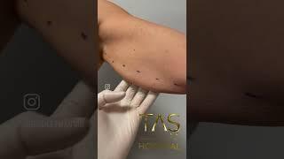 Revolutionary Scarless Arm Lift Achieve Toned Arms with Dr. TAS