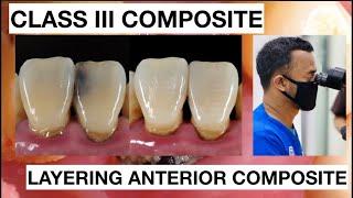 Step by Step Class III Composite Restoration  Dentist Griya RR