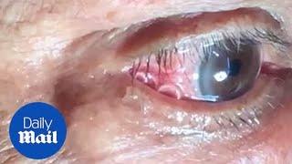 GRAPHIC Moment 15cm long worm is removed from mans eye