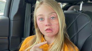 allergic reaction from bee sting... heres how it happened