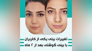 ویدیو تغییرات بینی یکی از کاربران بعد از ۲ ماه با بینی گوشتی