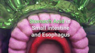 Stomach Acid in the Small intestine and Esophagus