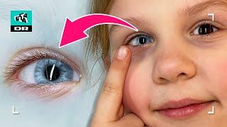 Har sjælden øjensygdom Får Sophia farve i øjnene?