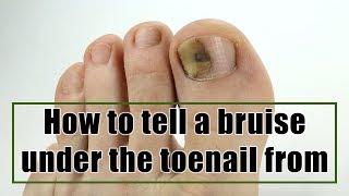 How to tell a bruise under the toenail from toenail fungus