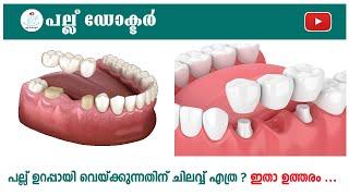 പല്ല്‌ ഉറപ്പായി വെയ്ക്കുന്നതിന്  ചെലവ്‌ എത്ര ? l Dental Bridge Costs What You Need to Know