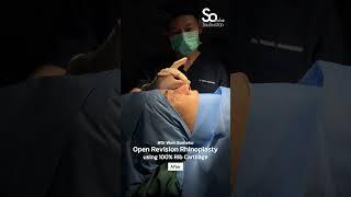 แก้จมูกปรับโครงสร้าง Secret Open กระดูกอ่อนซี่โครง #หมอเวียร์Someko #somekoclinic #โซเมโกะ