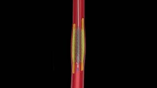 Angioplasty & Heart Blockage Explained in Animation