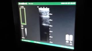 Bard Site Rite 6 Ultrasound System Video 2