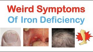 Weird Symptoms of Iron Deficiency  Nails Tongue Skin Hair & Others