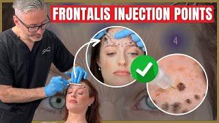 Injecting the Frontalis  Botox Injection Points & Safety Advice