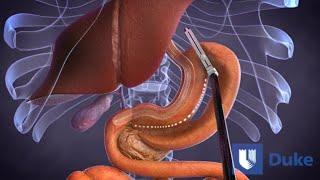 Duodenal Switch Surgery  Duke Health