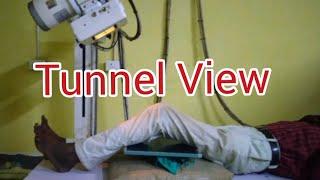 Knee Tunnel View  Beclere Method