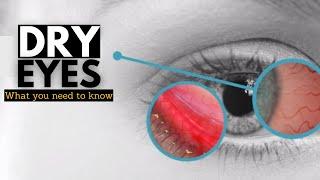 Dry Eye Syndrome Causes Signs and Symptoms Diagnosis and Treatment.