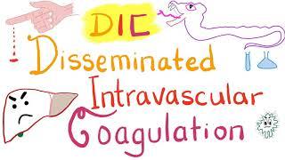 Disseminated Intravascular Coagulation DIC