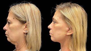 Facelift Before & After Real Patient Result for Facial Rejuvenation