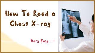 Chest  X-ray fundamentals  Hindi