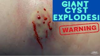 Watch This Giant Cyst SQUIRT 
