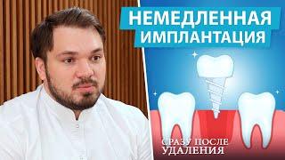 Можно ли ставить имплант сразу после удаления зуба? Одномоментная имплантация за 1 день