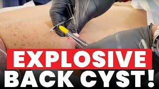 EXPLOSIVE BACK CYST