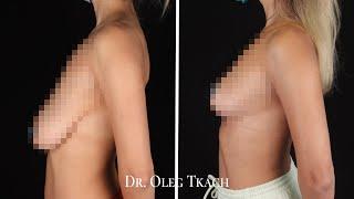 Результат Т-образной подтяжки груди  Подтяжка груди ДО и ПОСЛЕ  Мастопексия Киев  Маммопластика