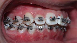 Quá trình niềng răng 2 năm How braces work for 2 years