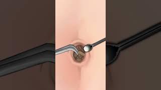 ASMR   Navel Stone  Belly Button Ring Remove Animation