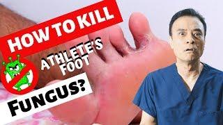 How to kill athletes foot fungus?