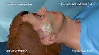 3D MACS and Neck Lift