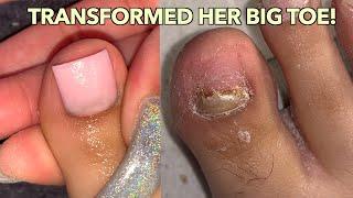 BIG TOENAIL TRANSFORMATION ACRYLIC BIG TOENAIL