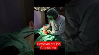 Removal of Skin Granuloma by Dr. Abdullah #shorts