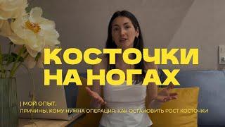 Операция Косточка на большом пальце ноги. Мой опыт. Халюс вальгус.