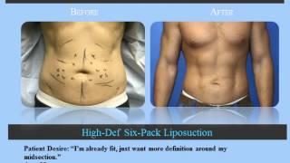 Male liposuction before and after photos of NYC patients