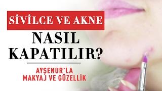 Sivilce ve Akne Kapama  Sivilce ve Akne  Nasil Kapatılır?