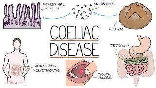 Understanding Coeliac Disease