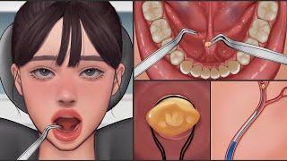 ASMR  Salivary Gland Stones Removal Animation