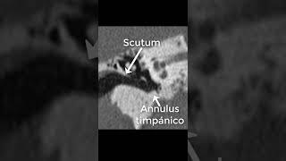 Scutum & Annulus Timpánico TAC