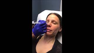 Tear Trough Injections with Juvederm Volbella