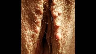 Excision of Genital Warts