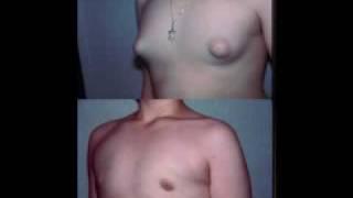 Dr. Blau  Gynecomastia Adolescent   Male Breast Reduction Teens