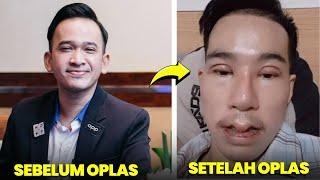 Tak sesuai harapan 8 artis mengaku menyesal setelah lakukan 0perasi hidung