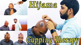 Cupping Therapy 3rd Session  Hijama treatment for hair regrowth  Hijama therapy for hair