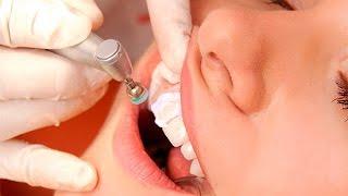 Механическое отбеливание зубов