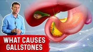 What Really Causes Gallstones? - Dr. Berg