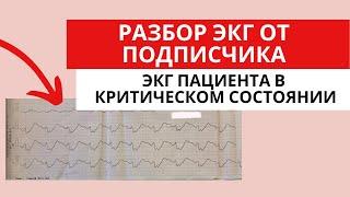 Разбор ЭКГ от подписчика. Пациент в критическом состоянии. Острый коронарный синдром