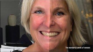 Visalys® CemCore - Cosmetic Treatment 10 veneers