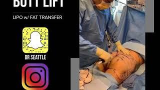 Best BBL Brazilian Butt Lift in Seattle by Dr. Sajan aka Real Dr. Seattle