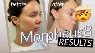 MORPHEUS 8 RESULTS BEFORE & AFTER  POSTPARTUM GLOW UP PLAN