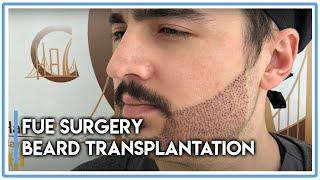 FUE Surgery Beard Transplantation in Hair of Istanbul Great Results